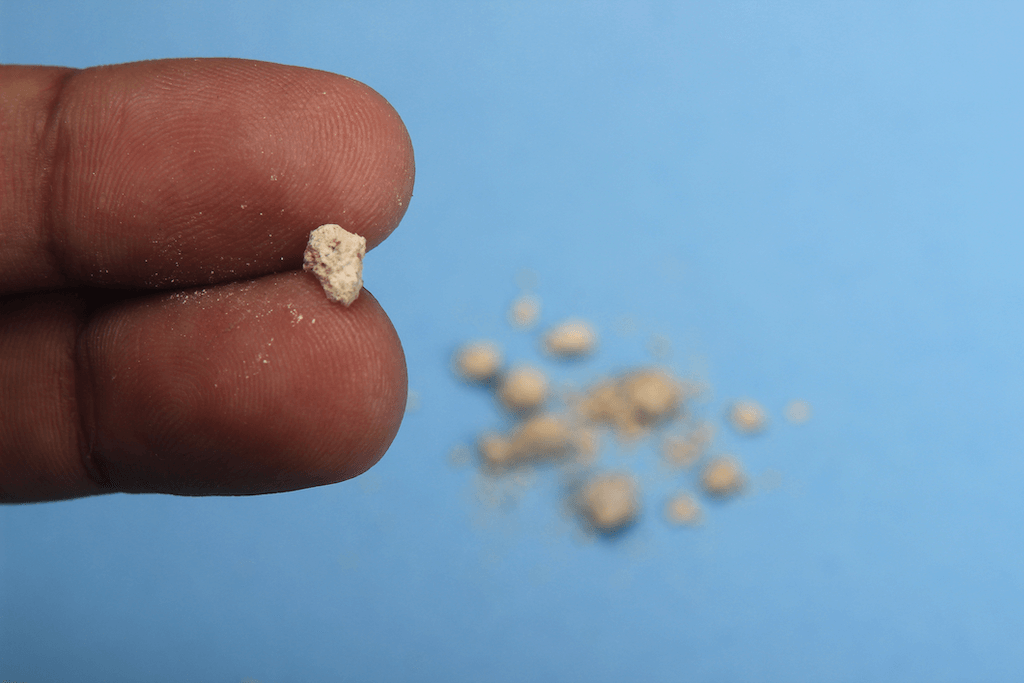How Kidney Stones Form and Prevention Tips